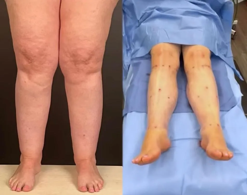Lipœdème des jambes – avant / après liposuccion WAL, photo 2
